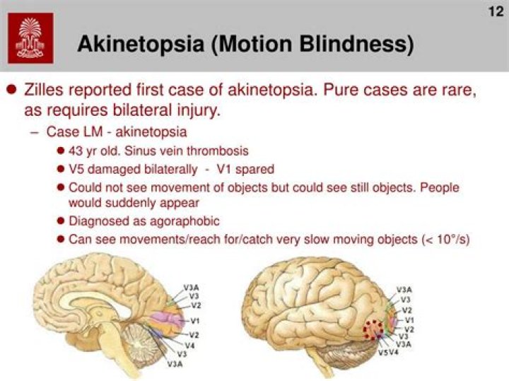 Akinetopsia: Motion Blindness