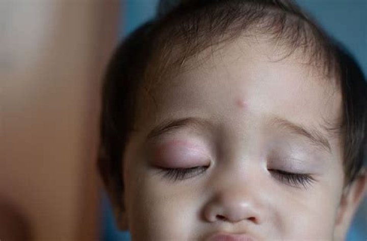 Eye Swelling In Toddlers: Diagnosis and Treatment