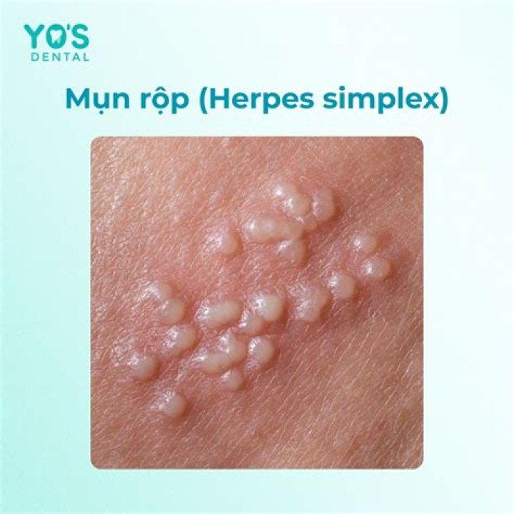 Mụn rộp ở mắt (herpes ở mắt)
