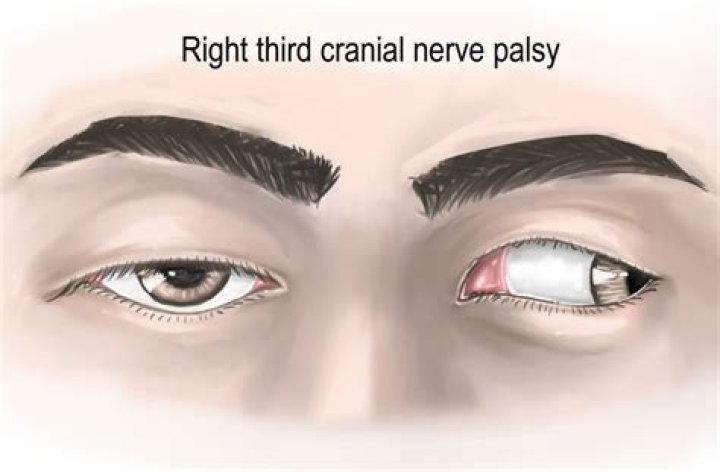 Third Nerve Palsy: Causes, Symptoms and Treatment