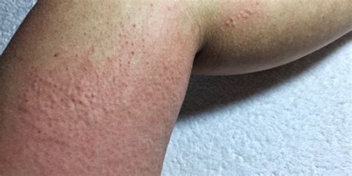 Urticaria por frío: cómo identificarla y tratarla