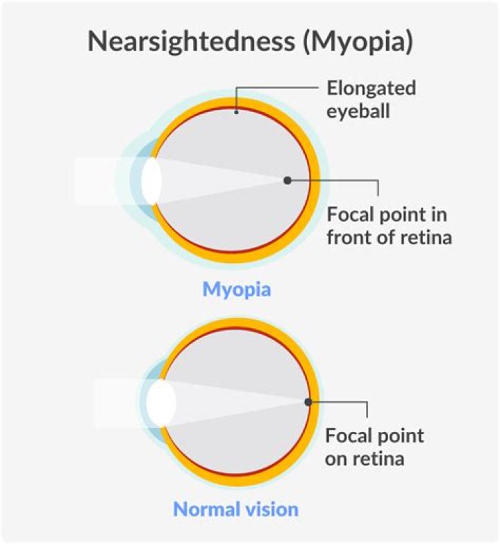 What Causes Myopia (short-sightedness)?